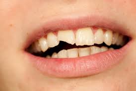 Child Dental Trauma
