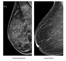If the mammogram is negative but the problem persists, an mri or biopsies of the red or. Mammograms And Dense Breasts Questions Abound