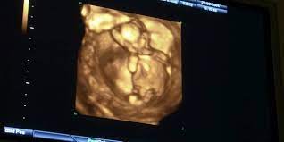 Das ultraschallbild ist der erste visuelle kontakt für eltern zu ihrem baby. Experten Raten Von Babyfernsehen Ab