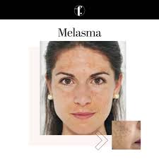 Image result for Melasma
