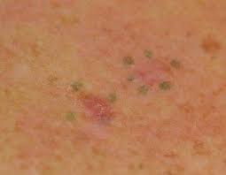 It just seems to be healing on its own now bit by bit. Basal Cell Skin Cancer Treatments Boston Wellesley Krauss Dermatology