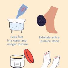 How to heal cracked heels at home with listerine is also an effective and fast way to get rid of the heel fissures. How To Heal Cracked Heels