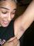 Cancer Lump In Armpit