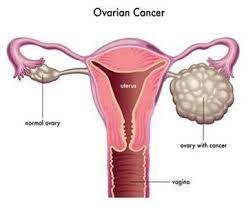 Ovarian cancer is the fifth most common cancer in women and the most common cause of gynecologic cancer deaths. Ovarian Cancer Oakwood Solicitors Ltd Leeds Law Firm