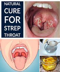 8 Effective Natural Home Remedies To Treat A Strep Throat Infection Natural Home Remedies Home Remedies Throat Infection