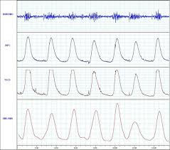 Comparing Uterine Electromyography Tocodynamometer To