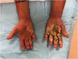 Image result for scabies norvegica