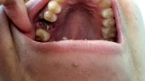 Image result for Dry Socket