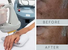 Sad to sell my baby. Laser Hair Removal Permanent Hair Reduction Avora Spa Coquitlam
