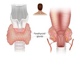 Image result for Hyperparathyroidism