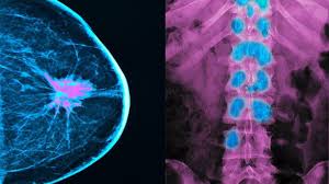 It often feels hard, like a lemon seed, and usually immovable. Everything You Need To Know About Breast Cancer Metastasis In Bones Everyday Health