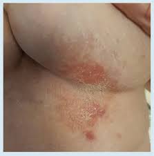 Image result for Intertrigo under breasts