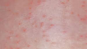 Image result for Trombicula autumnalis bites