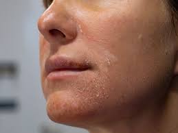 Actinic Keratosis Treatment in in Portsmouth, Dover & Exeter, NH