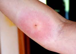 I felt a sharp little pain, something like a pin prick. Wolf Spider Bite Pictures Symptoms And Treatment