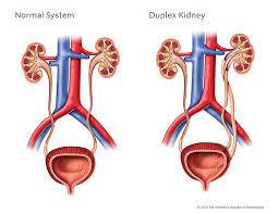 Duplex Kidney Children S Hospital Of Philadelphia