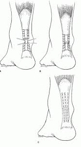 The commonly used krackow stitch has differences in mechanical behavior and security depending upon the suture size, number of locking loops, and number of strands. Acute Repair Of The Achilles Tendon Rupture Open And Limited Open Musculoskeletal Key