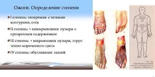 Termicheskij Ozhog Shei Grudnoj Kletki 1 2 Stepeni Kod Stancii 2667 Mkb T20 2 Termicheskie Ozhogi Golovy I Shei Vtoroj Stepeni Kod Stancii 2668 Mkb T20 4 Himicheskie Ozhogi Golovy I Shei Neutochnennoj Stepeni