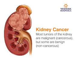Malignant tumors are cancerous and can spread cancer cells throughout one's body through the blood or lymphatic system, a process known as metastasis. Tumors In Kidney Kidney Cancer Causes Symptoms Diagnosis And Treatment