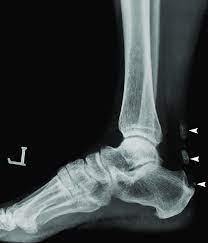 70 Year Old Man With Degenerative Calcification Of Achilles Tendon Who Download Scientific Diagram