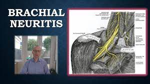 Brachial Neuritis Parsonage Turner Syndrome Youtube