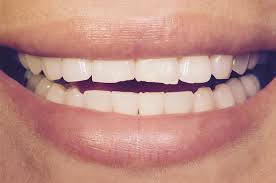 How To Fix Worn Down Teeth Treatment And Repair Vancouver