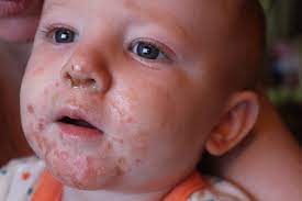 Penyakit hfmd disebabkan oleh virus yang dikenali sebagai enterovirus meliputi coxsackie virus a16 (cox a16) dan enterovirus 71 (ev 71). 5 Perkara Penting Mengenai Penyakit Tangan Kaki Dan Mulut Hfmd Yang Anda Patut Tahu Iluminasi