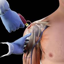 Image result for Intraosseous Access