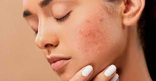 Sel yang lepas itu akan meninggalkan permukaan kulit yang 'terbuka' dan terasa perih. Ini Penyebab Kulit Kering Dan Perih Setelah Dibersihkan