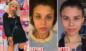 These two small circles are. Women Are Getting 800 Under Eye Bag Filler To Remove Dark Circles Daily Mail Online