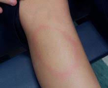 Lyme Disease Symptoms Lymedisease Org