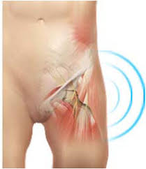 Image result for Snapping Hip