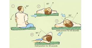 Epley maneuver for benign positional vertigo 1. Benign Paroxysmal Positional Vertigo After Osteotome Use