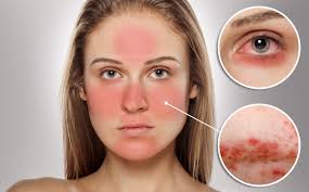 Résultat de recherche d'images pour "rosacea"