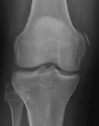 With the ayurvedic treatment, it is possible to avoid surgery. Pelligrini Stieda Lesion Litfl Medical Eponym Library