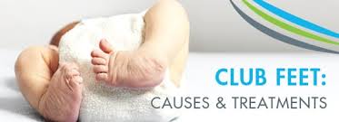 Clubfoot is a congenital foot deformity affecting the shape or position of one or both feet. Club Feet Causes And Treatments Top O C Surgery Center Crown Valley Surgical