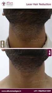With milan's exclusive unlimited package™, your results are guaranteed for life. Permanent Laser Hair Removal Treatment Cost At Andheri West Mumbai India