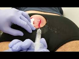 20 jahre alter pickel wird endlich ausgedrückt mehr seit zwanzig jahren hatte diese frau eine verstopfte pore, die sie nun endlich professionell ausdrücken ließ. Doktor Pickel Zyste Kochen Knallen Volles Video