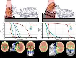 Optimizing Patient Positioning For Intensity Modulated Radiation Therapy In Hippocampal Sparing Whole Brain Radiation Therapy Practical Radiation Oncology