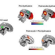 Brain Areas Showing Post Ayahuasca Statistically Significant Changes In Download Table