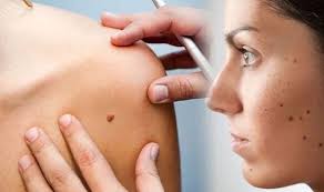 Many people can have more or less than this, but people who have abnormal growth of moles on the body is the indication of cancer. Skin Cancer Does Your Mole Look Like This Pictures Reveal A Person S Cancer Risk Express Co Uk