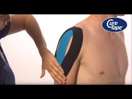 Image result for Shoulder Subluxation