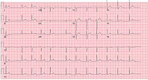 Lyme Carditis Presenting As Atrial Fibrillation In A Healthy Young Male Bmj Case Reports
