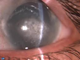 Residents and fellows contest rules | international ophthalmologists contest rules. Band Keratopathy Wikipedia