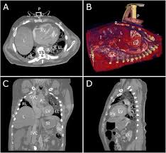 A Look Inside Cardiopulmonary Resuscitation A 4d Computed Tomography Model Of Simulated Closed Chest Compression A Proof Of Concept Sciencedirect