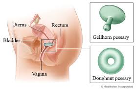 Image result for Pessary
