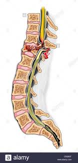 T12 Burst Fracture With Complete Spinal Cord Injury Stock Photo Alamy