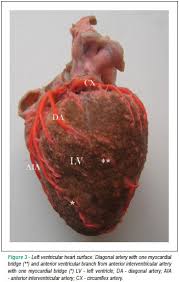An inconstant artery, occasionally duplicated, arising from the trunk of the left coronary artery and crossing the anterior aspect of the left ventricle diagonally, toward the left margin. Morphological Description And Clinical Implications Of Myocardial Bridges An Anatomical Study In Colombians