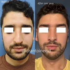 Rhinoplasty 8 days post surgery. I am so happy to see my patient happy 😊