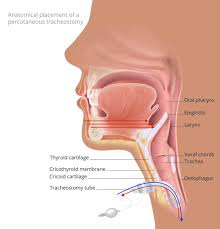 Image result for Tracheostomy